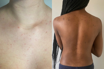 Body acne on different skin tones (left: light skin, right: dark skin)