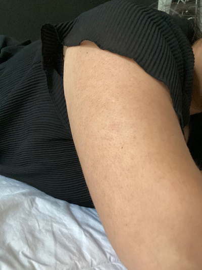 Keratosis Pilaris