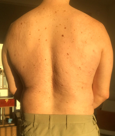 Scarring, Body Acne