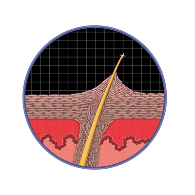 Illustration: KP is bumps of dead skin cells that form around the hair follicle