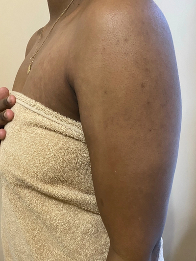 Body Acne, Scarring