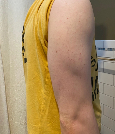 Keratosis Pilaris