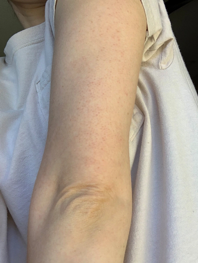 Keratosis Pilaris