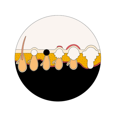 From left to right: healthy pore, whitehead, blackhead, papule, pustule, cyst/nodule